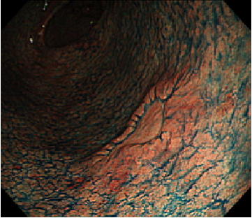 色素内視鏡検査（早期胃がんのインジゴカルミン散布像）　画像提供：田中信治先生