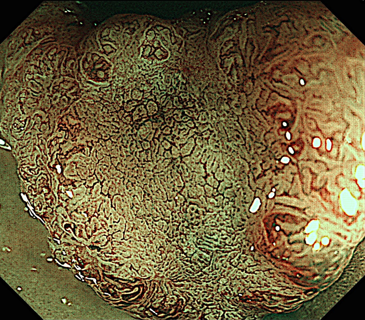 早期大腸がんのNBI拡大内視鏡観察像 画像提供:田中信治先生
