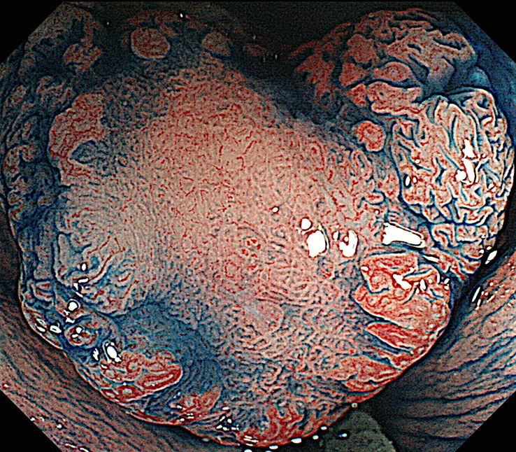 早期大腸がんのインジゴカルミン散布拡大内視鏡観察像 画像提供:田中信治先生