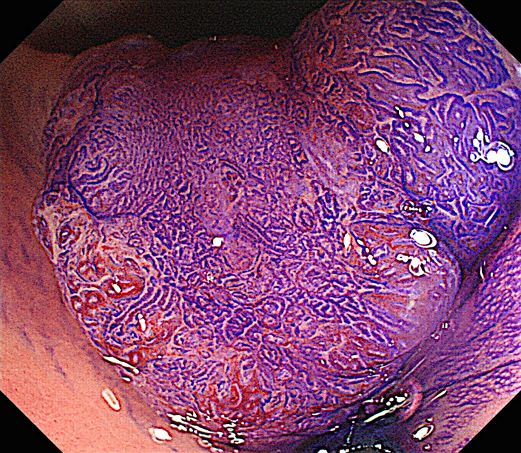 早期大腸がんのクリスタルバイオレット染色拡大内視鏡観察像 画像提供:田中信治先生