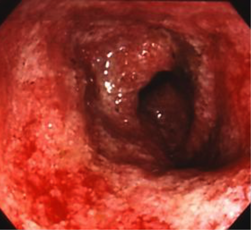 潰瘍性大腸炎の内視鏡検査