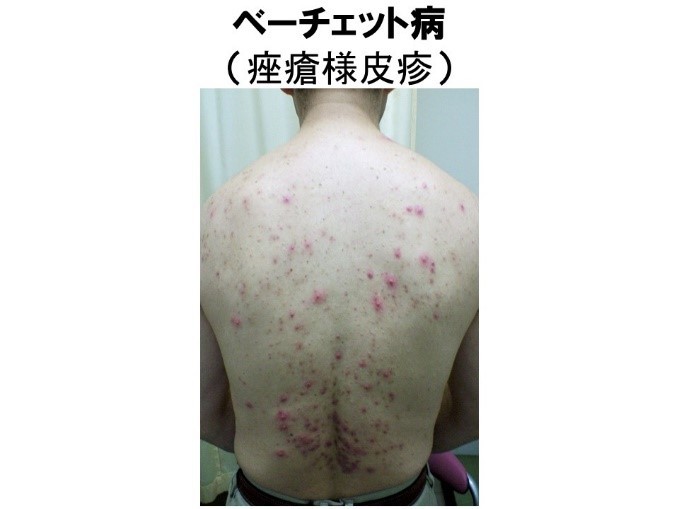(ざ瘡様発疹の症例写真:ご提供 帝京大学医学部内科学講座 菊地弘敏先生)