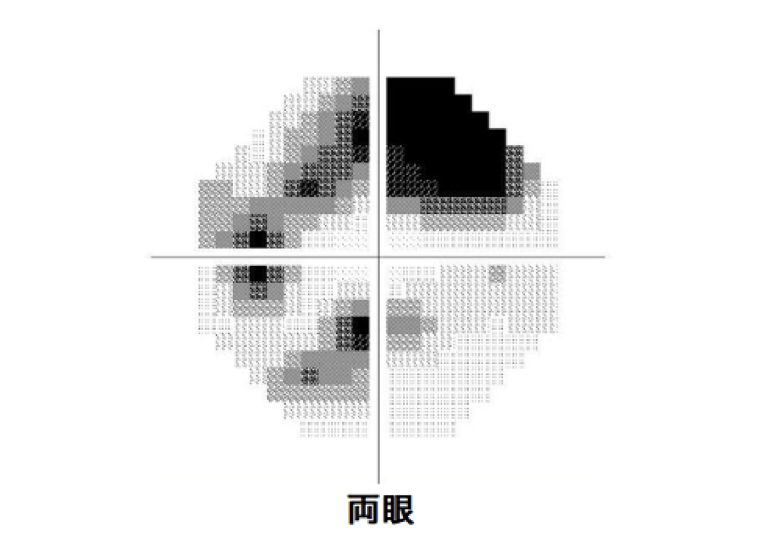 緑内障の視野障害2