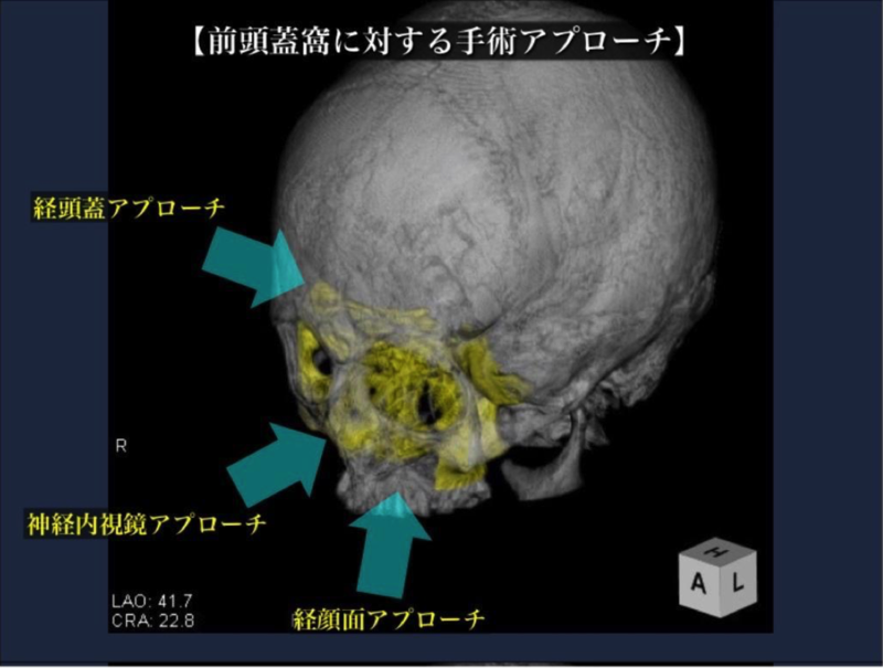 頭蓋底腫瘍の手術治療1