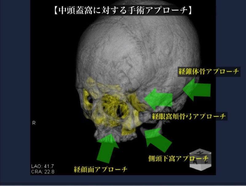 頭蓋底腫瘍の手術治療2