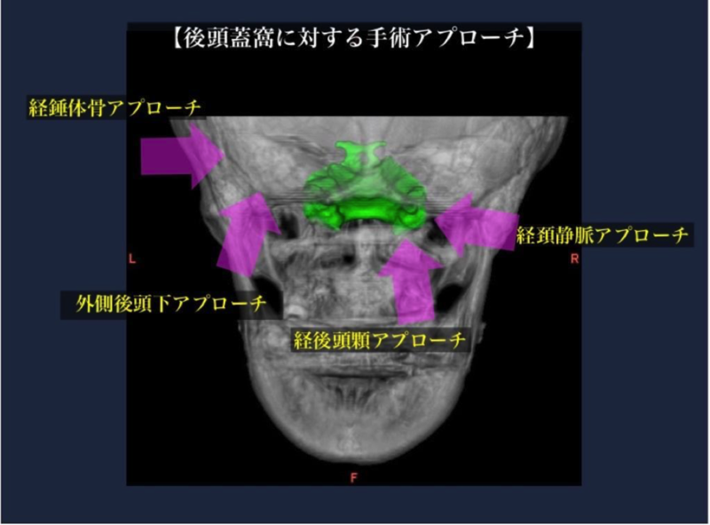 頭蓋底腫瘍の手術治療3
