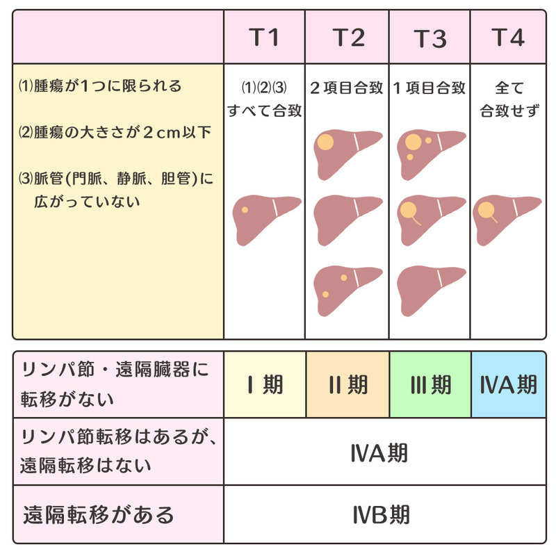 肝臓ガンのステージ
