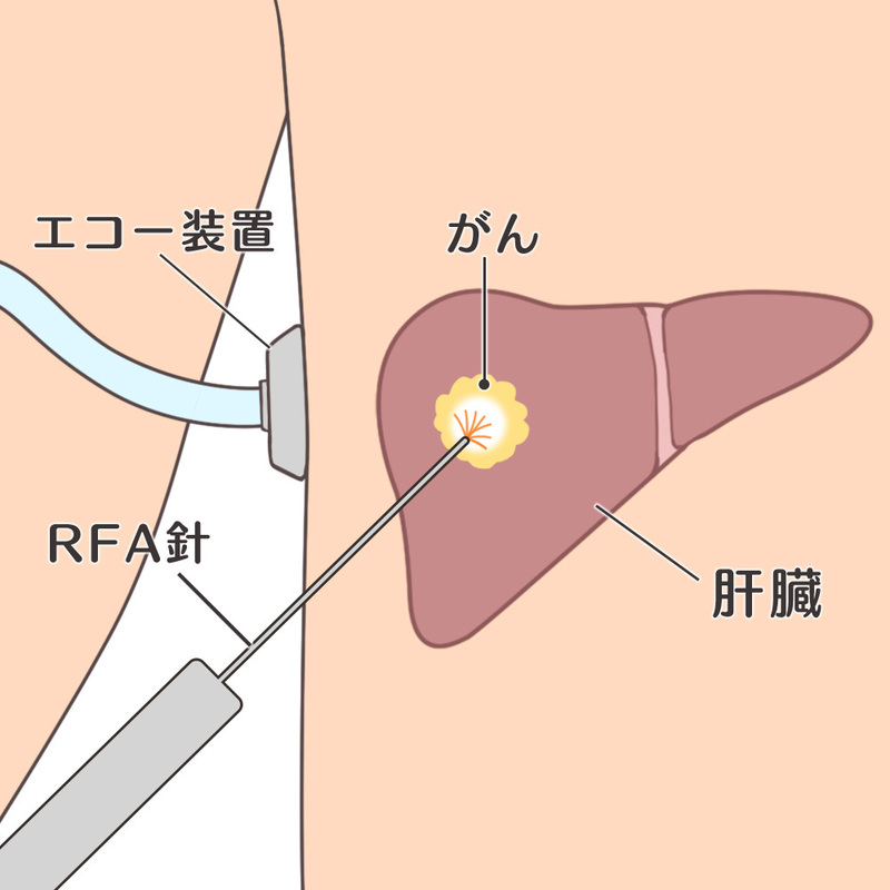 穿刺局所療法