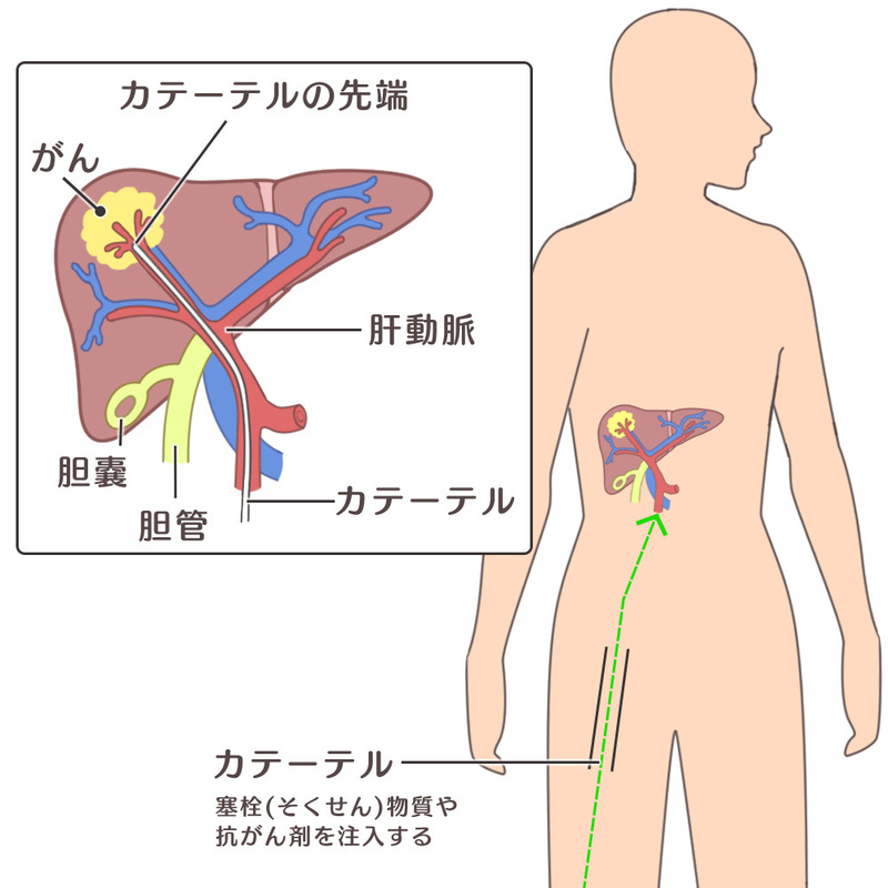 肝動脈塞栓療法