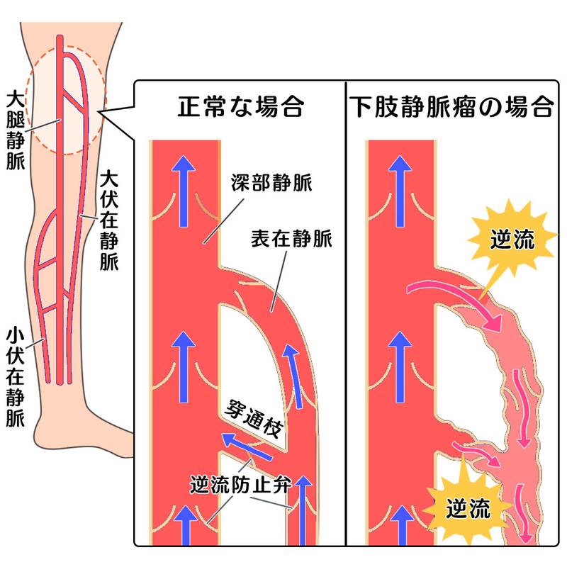 下肢静脈瘤のメカニズム