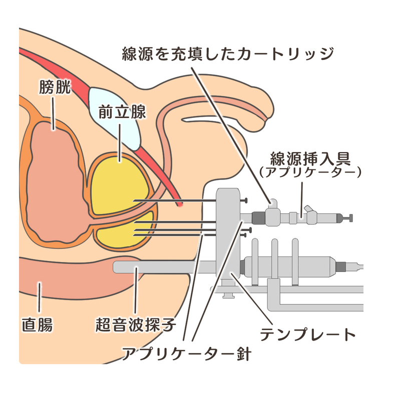 組織内照射療法のイメージ
