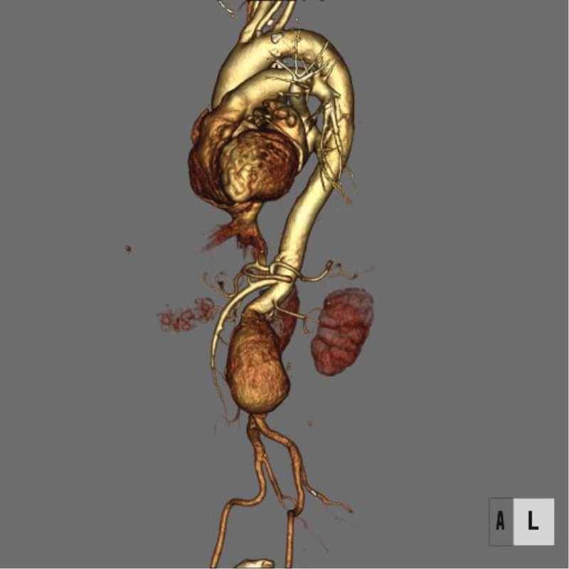 ステントグラフト治療後