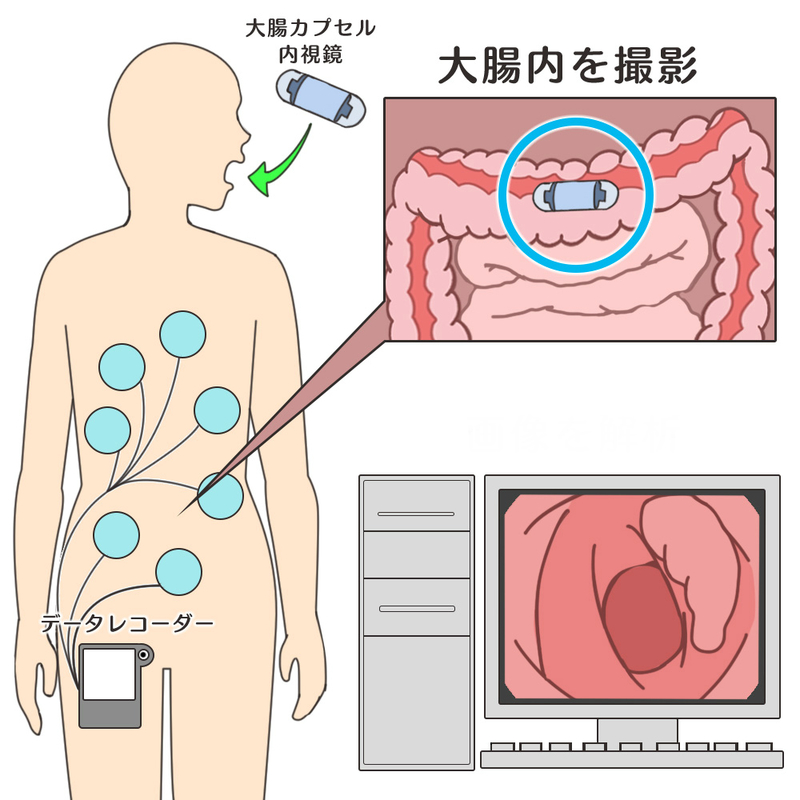 カプセル内視鏡検査のイメージ