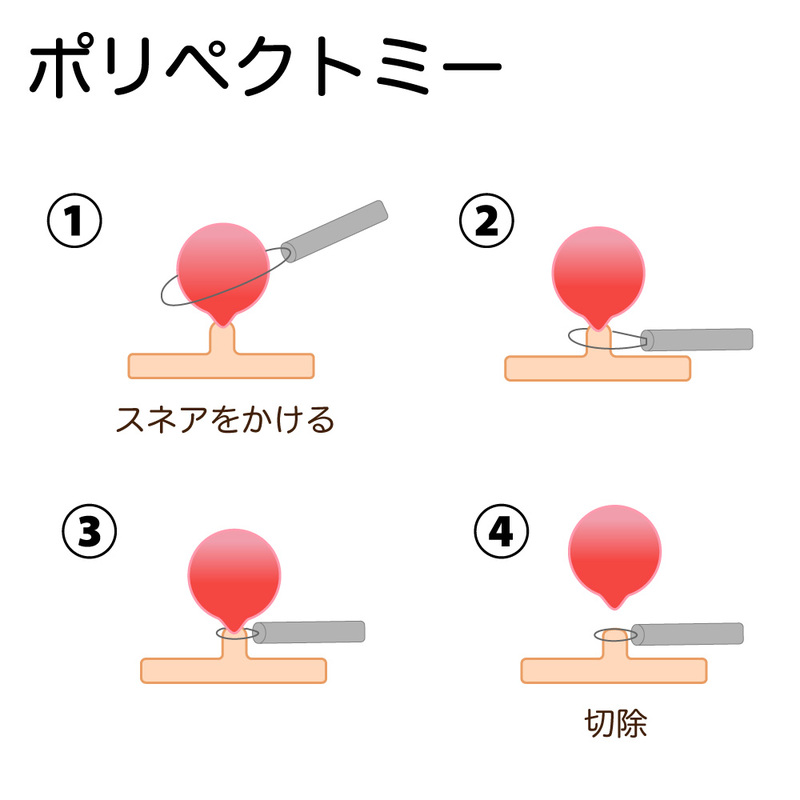 内視鏡的ポリープ切除術(ポリペクトミー)