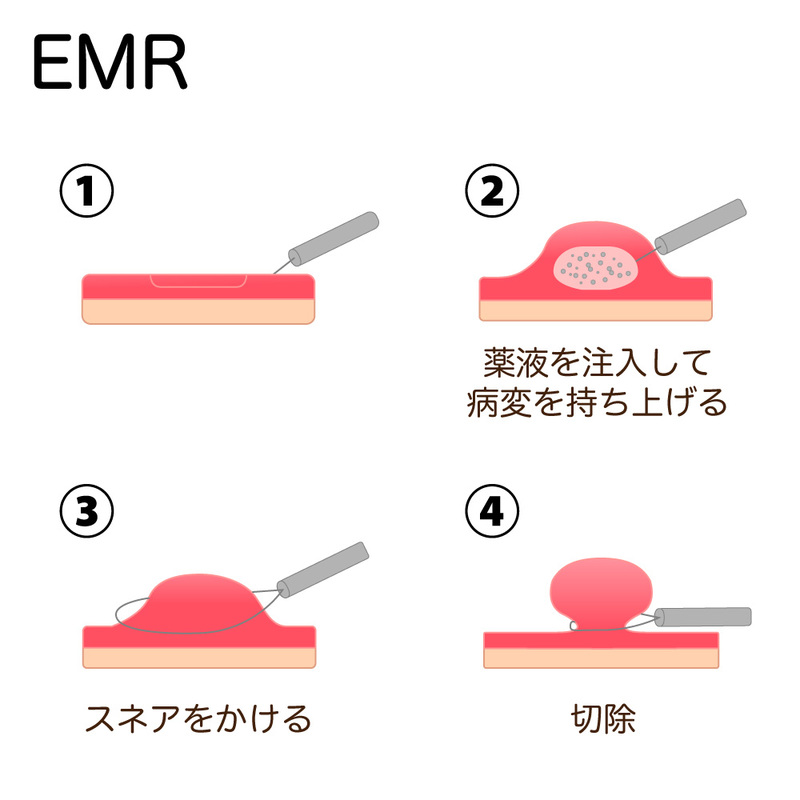 内視鏡的粘膜切除術のイメージ