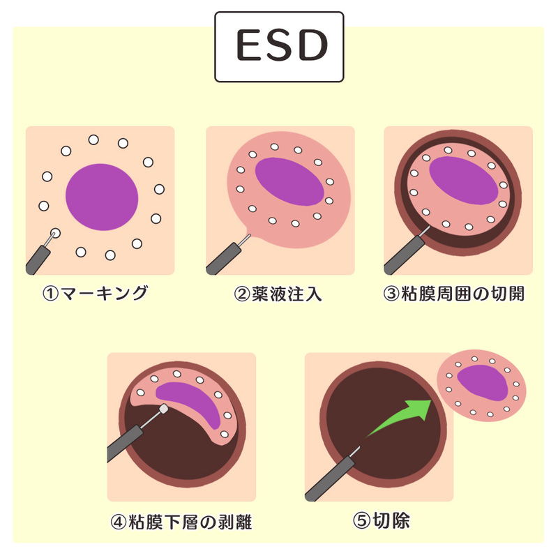 内視鏡的粘膜下層剥離術(ESD)