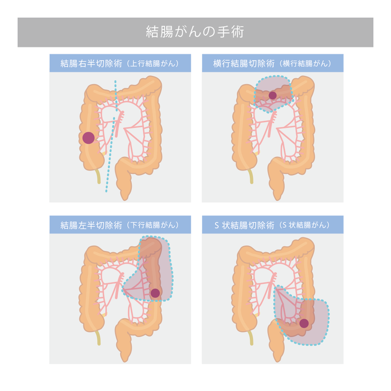 結腸がんの術式
