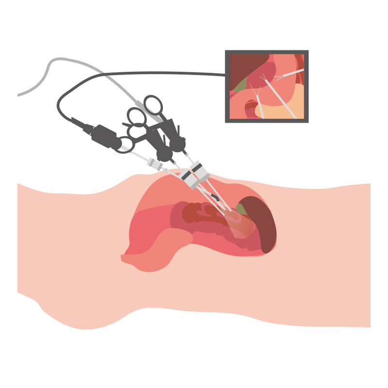 腹腔鏡手術のイメージ