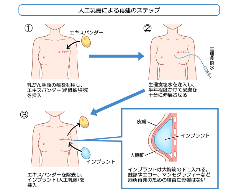 人工乳房による再建術の方法
