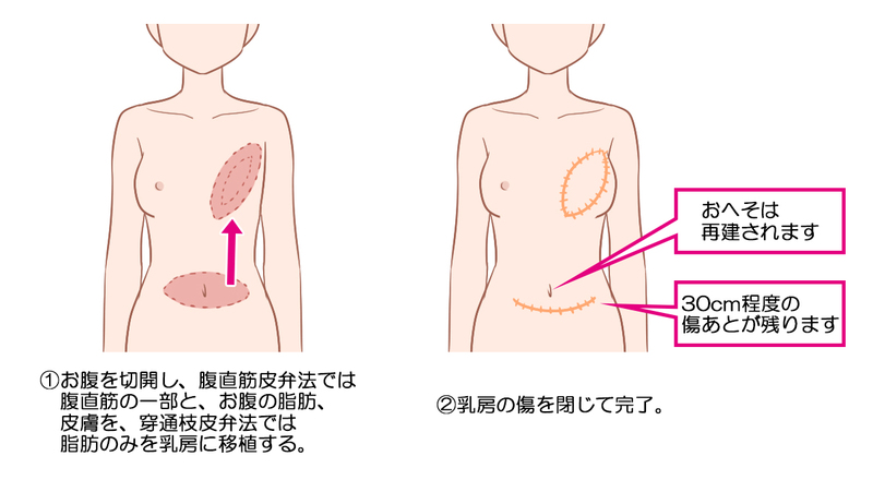 自家組織(お腹)による再建の方法