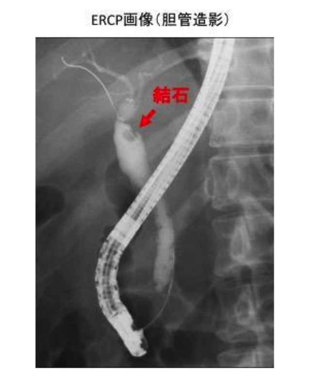 胆管造影でみた結石