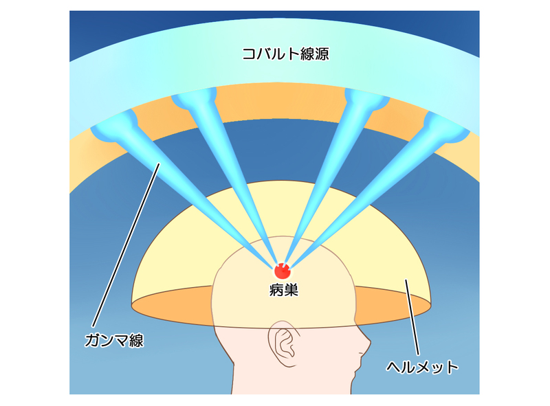 ガンマナイフ治療のイメージ