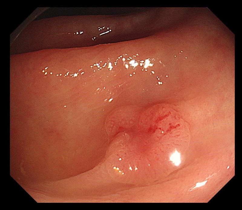 陥没型早期大腸がん(真ん中がくぼんでいる) 佐々部正孝先生ご提供