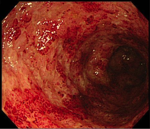 潰瘍性大腸炎の内視鏡所見