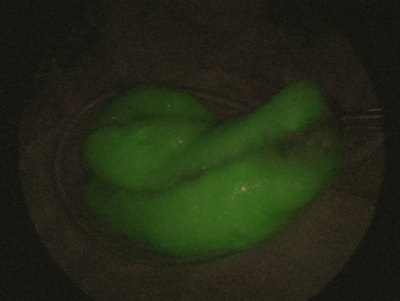 ICG蛍光画像:緑に発光され腸管の血流が良好であることがわかる(写真ご提供:JR札幌病院)