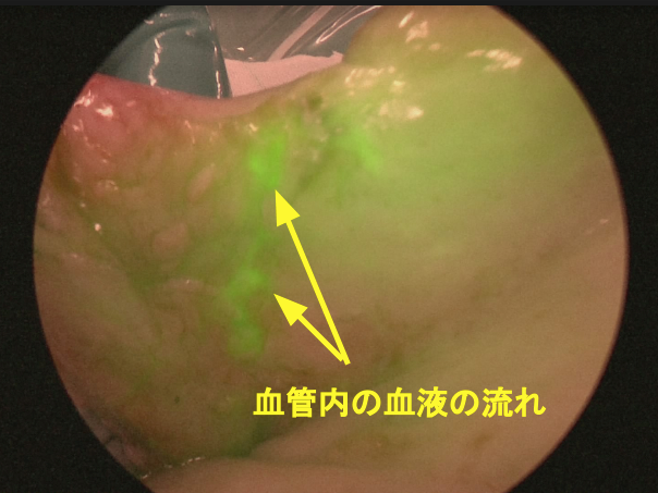 ICG蛍光画像:血管内の血流が緑色に発光される(写真ご提供:JR札幌病院)