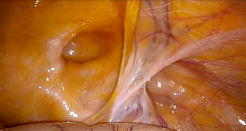 腹腔内からみたヘルニア門(穴)