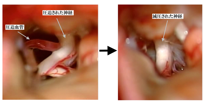 微小血管減圧術の実際