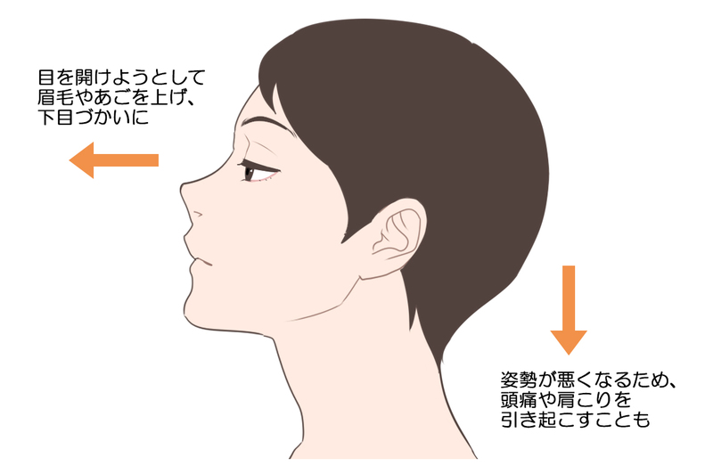 眼瞼下垂症では無理な姿勢をとりやすい