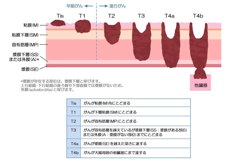 深達度のイメージと分類