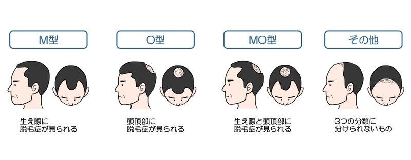 AGAの脱毛の特徴によるタイプ分類