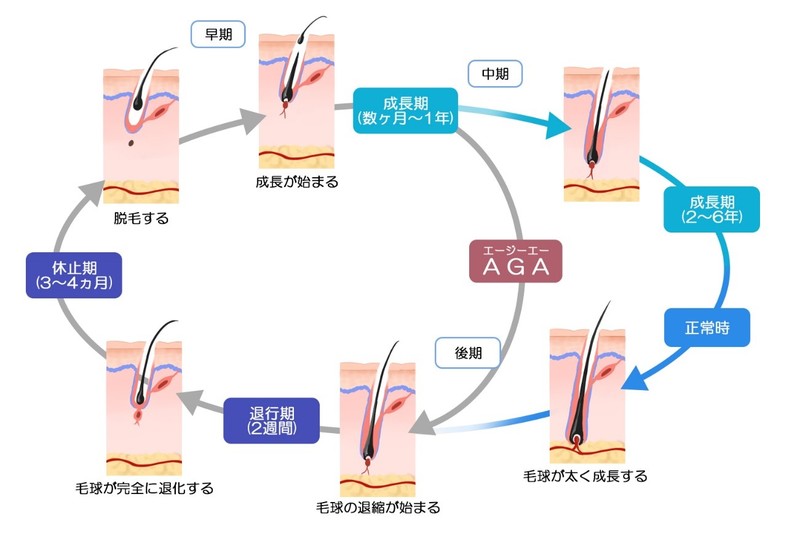 正常の発毛サイクルとAGAの発毛サイクルの違い