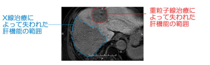 粒子線とX線の被ばく量の差