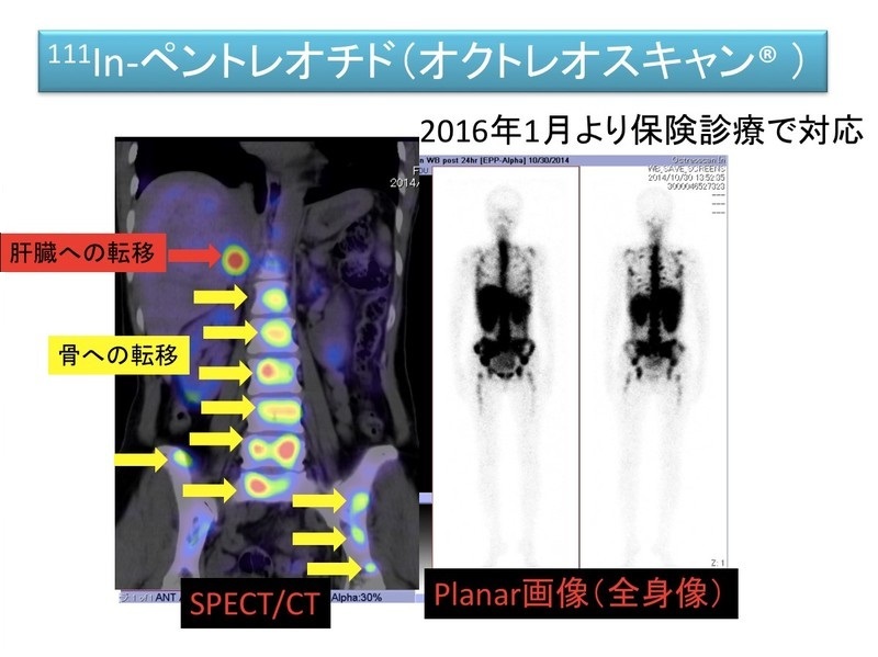 ペントレオチド