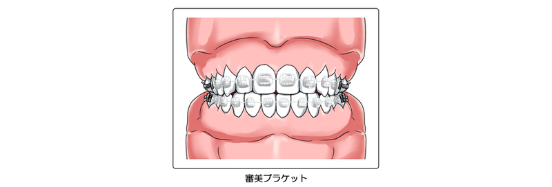 審美ブラケット