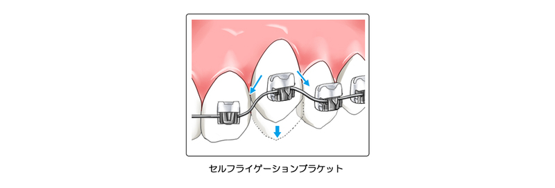 セルフライゲーションブラケット