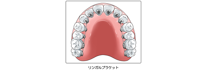 リンガルブラケット