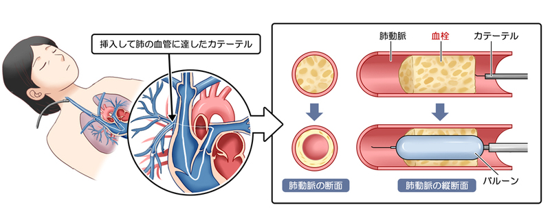 バルーン肺動脈拡張術