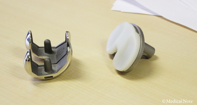 人工膝関節全置換術(TKA)に用いられる膝の人工関節