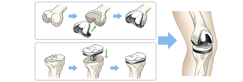 人工膝関節全置換術(TKA)