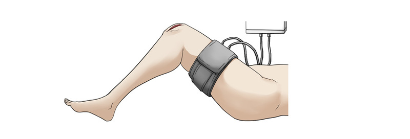ターニケットによる下肢圧迫