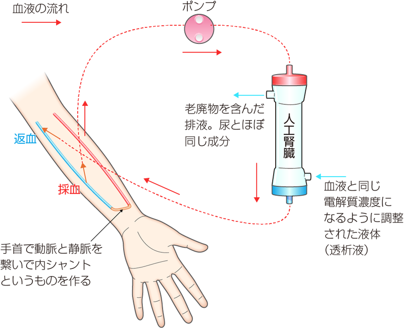 糖尿病腎症の透析治療
