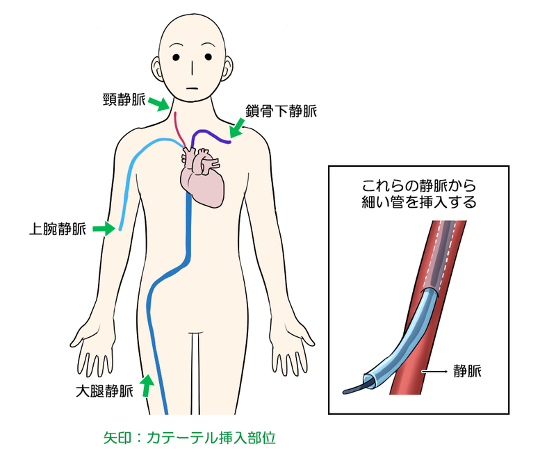 肺高血圧症の検査方法