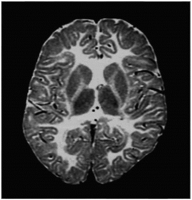 先天性大脳白質形成不全症