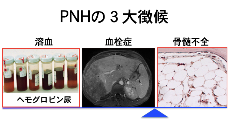 PNHの3大徴候