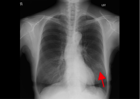 肺がんのレントゲン画像